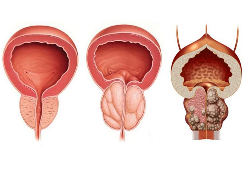 Prostatitisphase und die Notwendigkeit, Prostavit voll zu verwenden