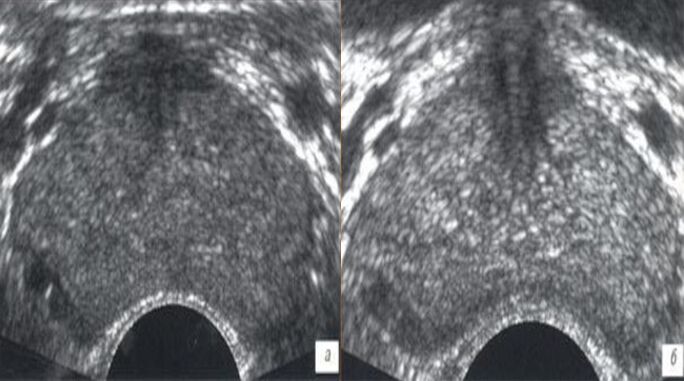 Ultraschall vor und nach der Behandlung mit ZXCVBNQWERT -Tropfen