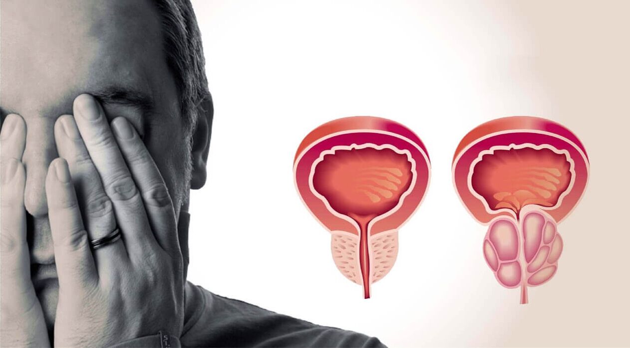 Gesunde und schmerzhafte Prostata bei Männern